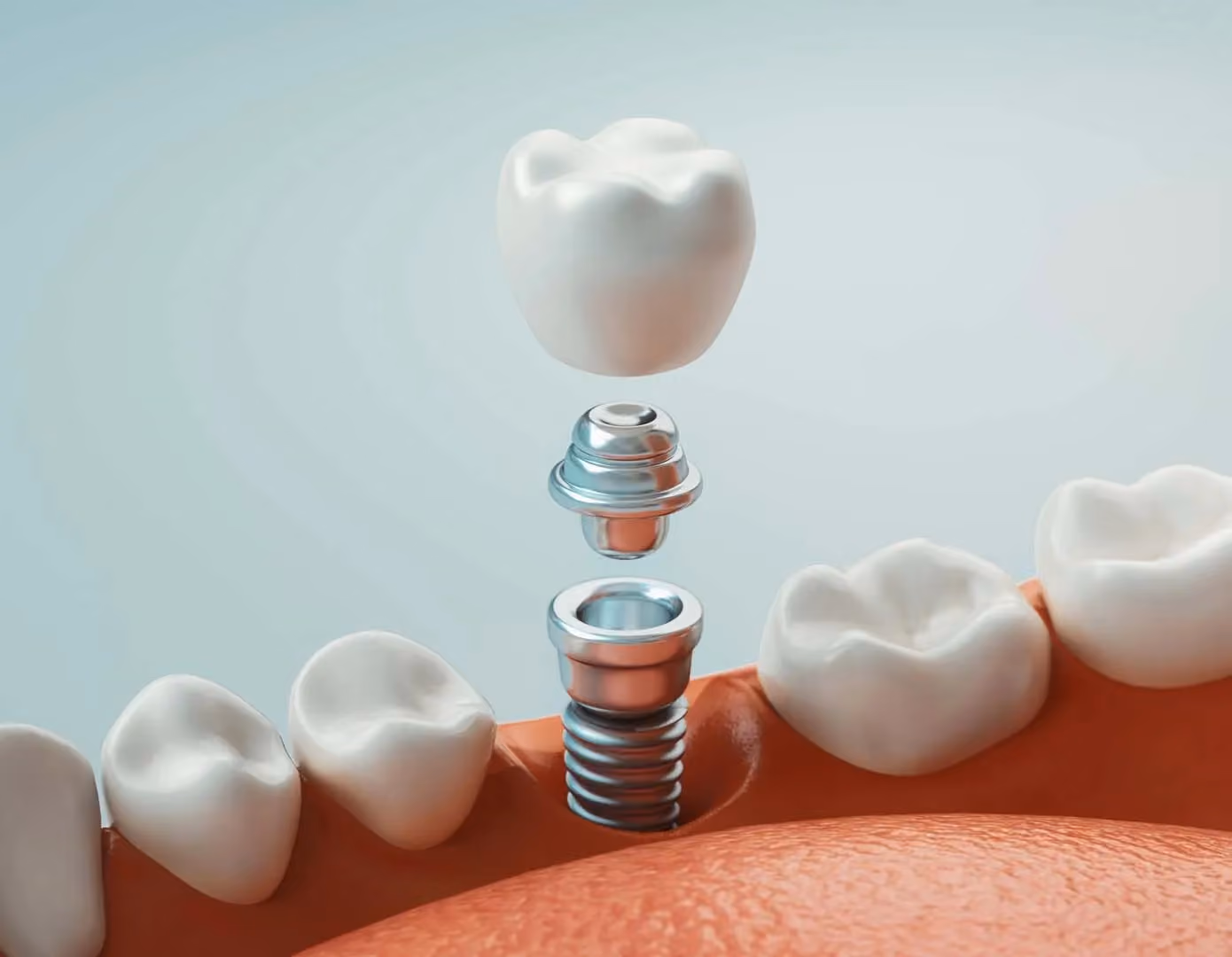 Dental Implants